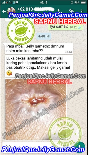 Obat Luka Borok Bernanah Dan Berair, Menyembuhkan Luka Borok Bernanah dan Berair Sampai Sembuh Total Obat Luka Borok Bernanah Dan Berair, Menyembuhkan Luka Borok Bernanah dan Berair Sampai Sembuh Total