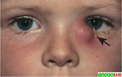 Dacryocystitis (infection of the lacrimal sac) of the left eye (arrow) in a young child. Dacryocystitis (infection of the lacrimal sac) of the left eye (arrow) in a young child.