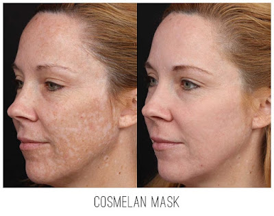 Cách dùng kem trị nám Cosmelan 2 hiệu quả Cách dùng kem trị nám Cosmelan 2 hiệu quả