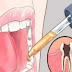 Mira como eliminar el dolor de muelas en 1 minuto con este remedio casero. ¡Te sorprenderás!
