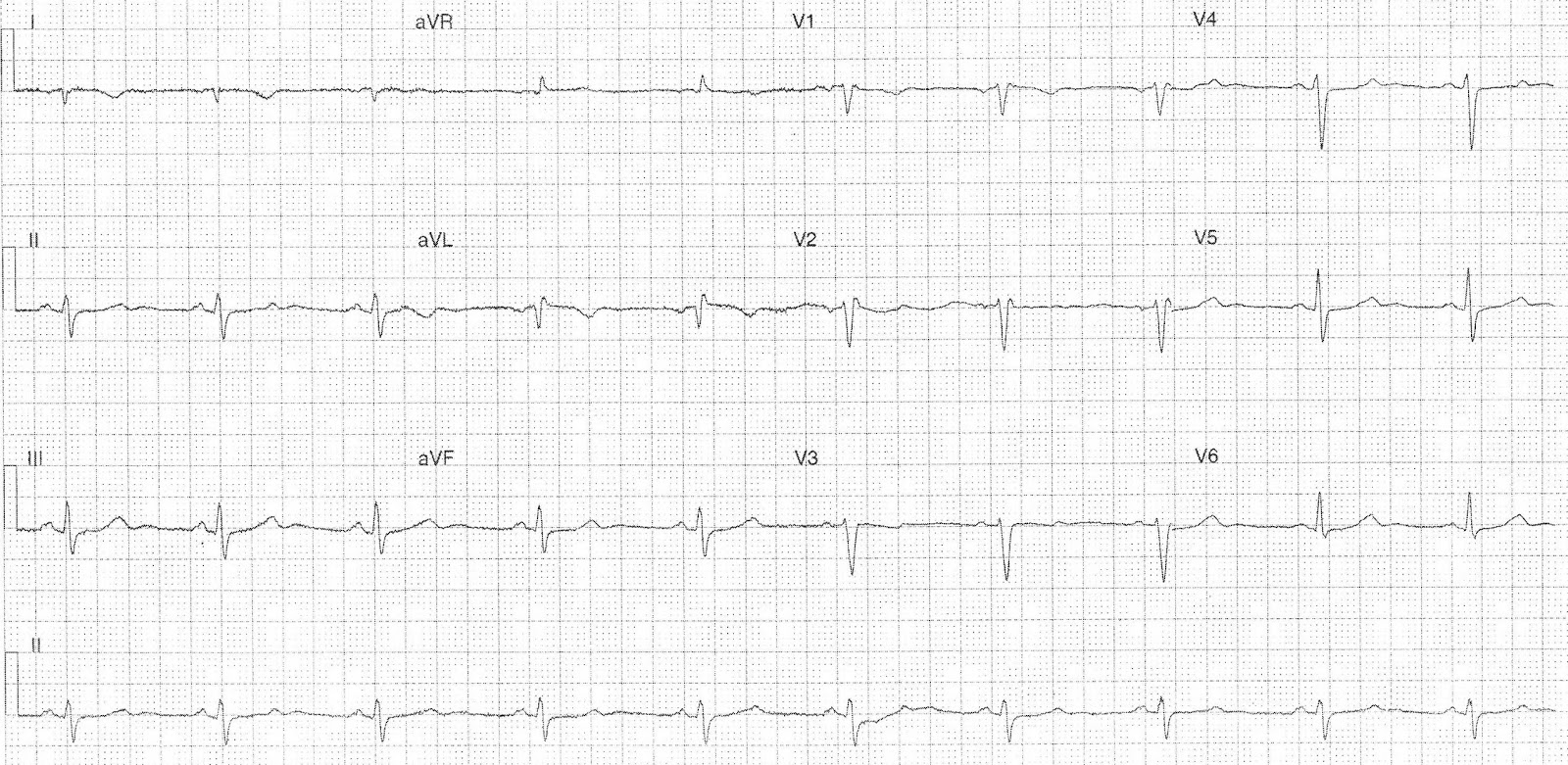 ECG of the Week: ECG of the Week - 15th October 2018 - Interpretation
