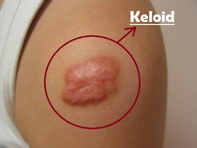 Obat Keloid Resep Dokter Obat Keloid Resep Dokter