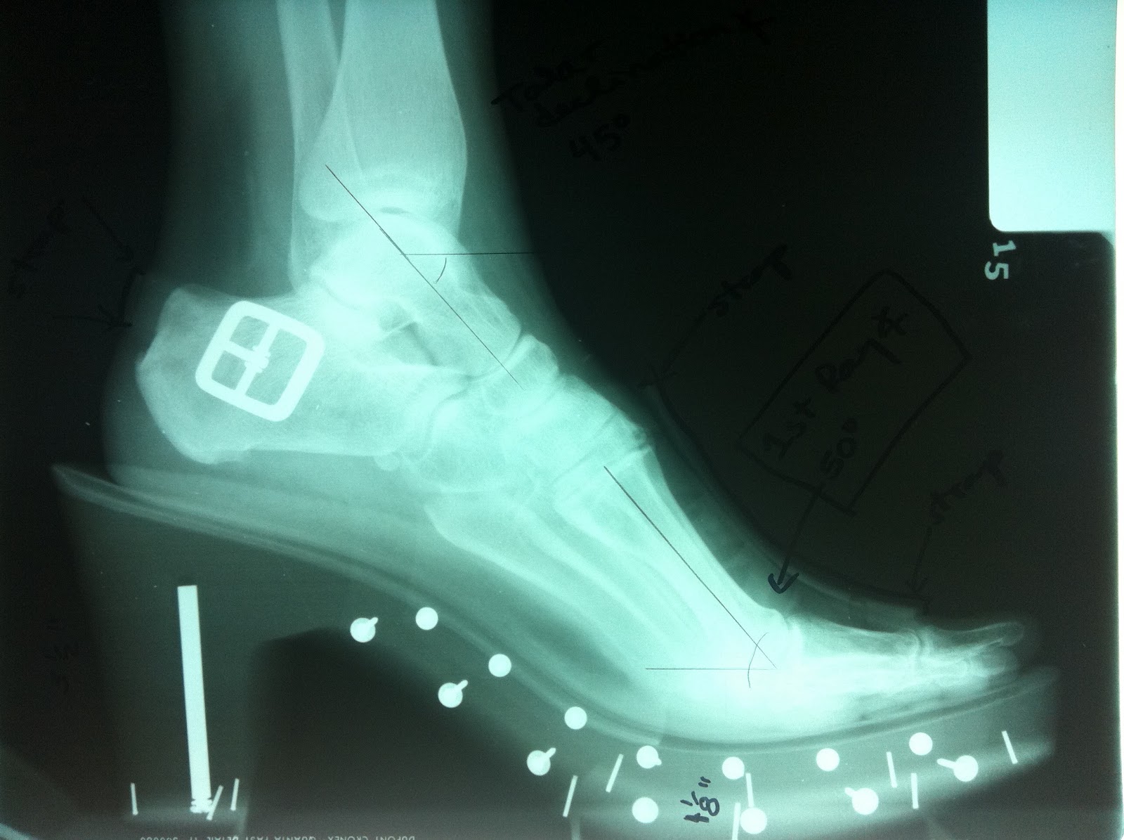 Podiatry Shoe Review The Effects of Wearing High Heel Shoes on Your