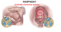 Nama Obat Gonore di Apotek Terbaik Pasti Sembuh Total