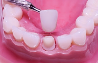 Cách trồng răng giả như thế nào đảm bảo tiêu chuẩn Quốc tế?