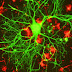 Study Shows THC Removes Alzheimer Plaque From the Brain