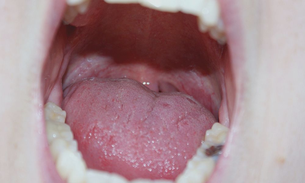imagenes del papiloma humano en la boca