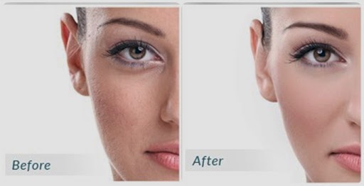 get rid of lines under eyes