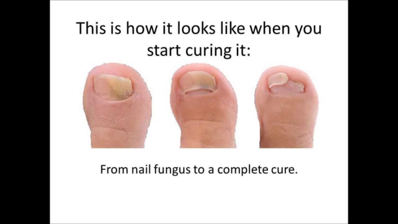 Best Natural Remedy For Fungal Toenails Best Natural Remedy For Fungal Toenails