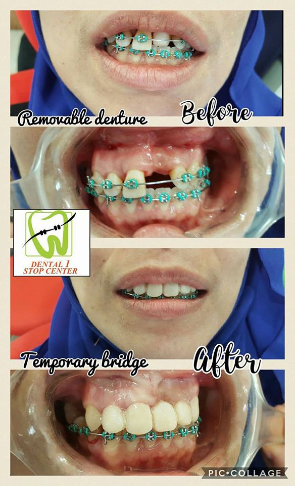 KLINIK PERGIGIAN SYARIFAH Nak pakai braces?