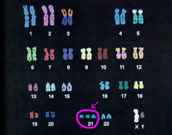Набор дауна. Трисомия 21 хромосомы (синдром Дауна кариотип. Синдром Дауна 21 хромосома. Синдром Дауна трисомия 21 хромосомы. Трисомия 21 хромосомы кариотип.