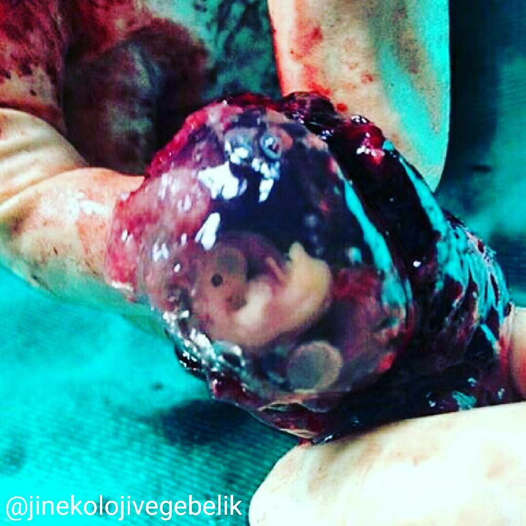 Hamilelik Nedir Hamilelik Nedir