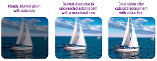 Toric Vision With Astigmatism