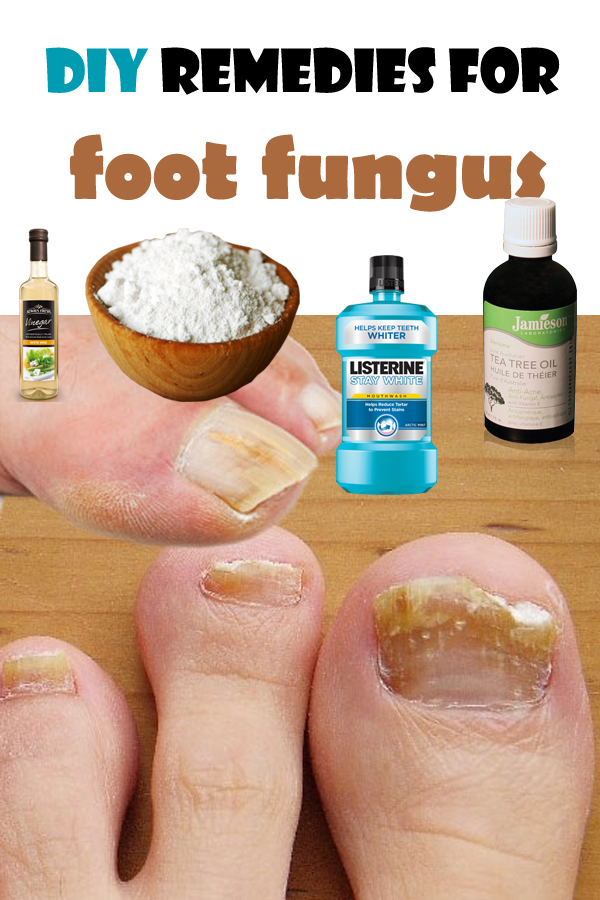 DIY remedies for foot fungus | Top Health Remedies