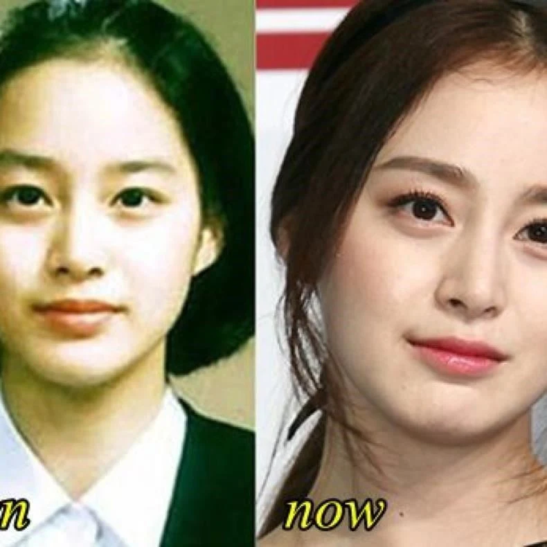 kim tae hee plastic surgery before and after pictures