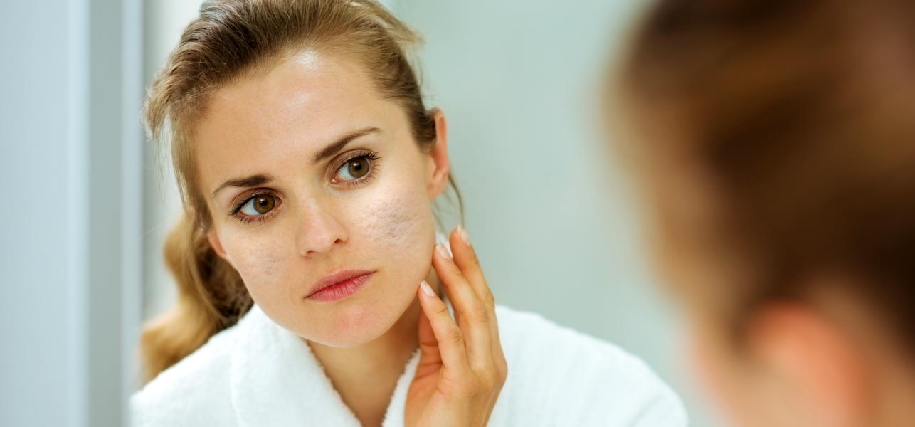 How To Use Lemon Juice For Acne Scars? Family Health Articles