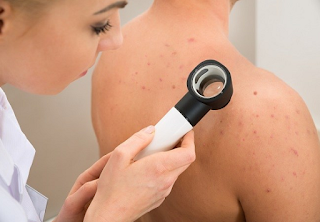 Nodulocystic acne Nodulocystic acne