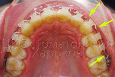 Нанесение изгибов на проволочной дуге
