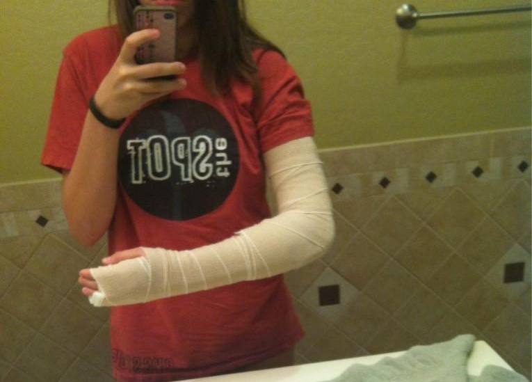 Casts and Toes Arm Casts!!!