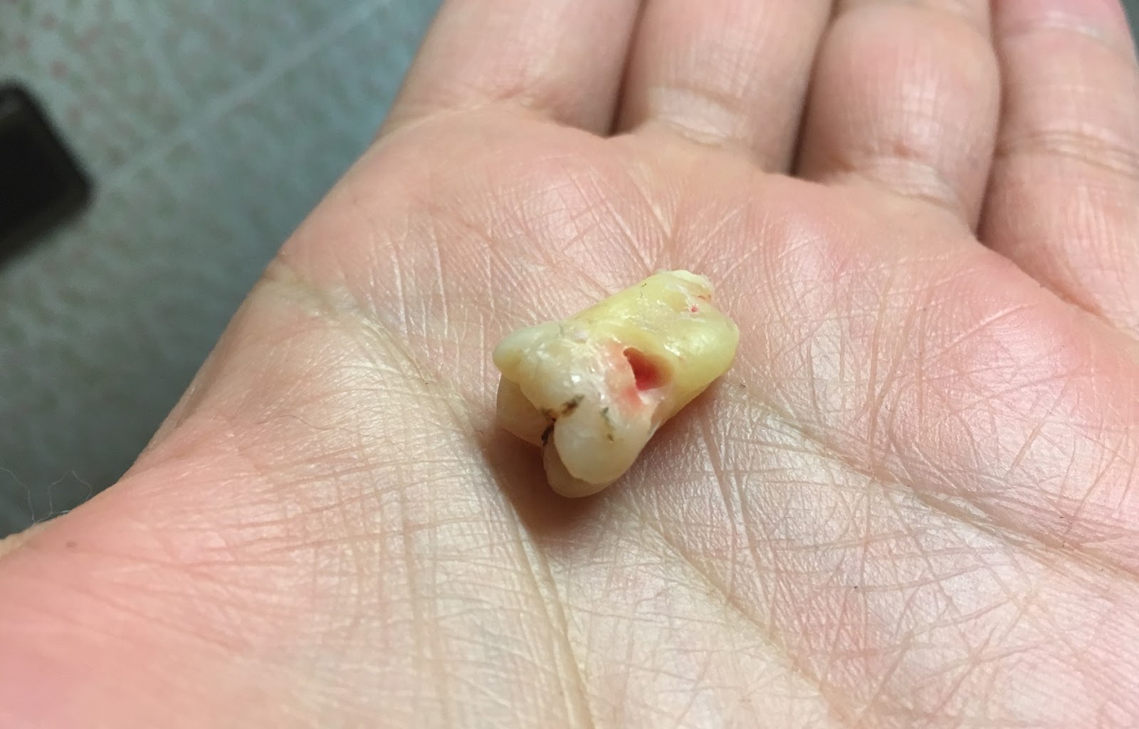 Birger Unterwegs Weisheitszahn Ziehen Lassen Ein ebuch