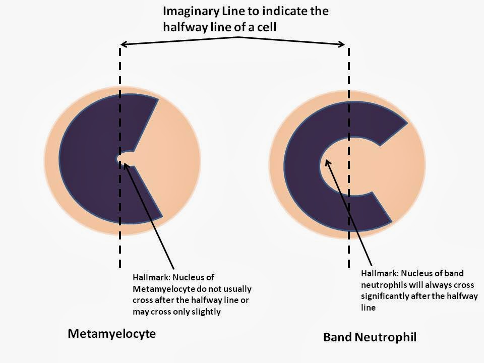 Haematology in a NutShell Immature Granulocytes in PBFs