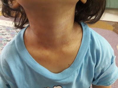 eczema pada kanak-kanak
