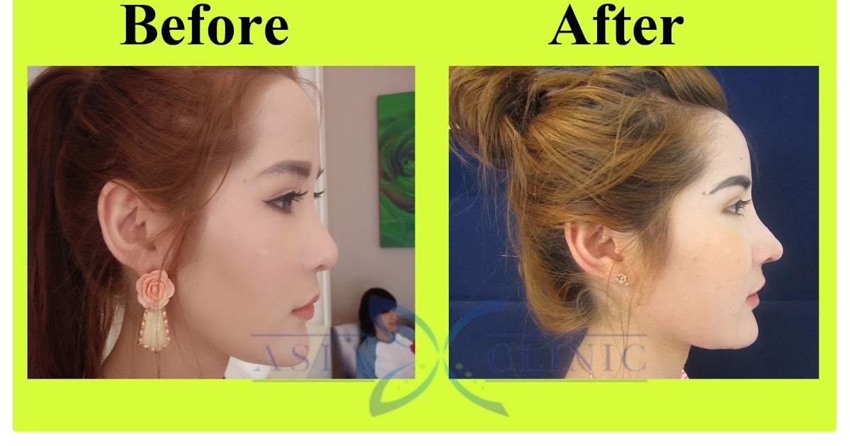 Rhinoplasty Surgery Thailand Nose Augmentation Before And After Photos Rhinoplasty Surgery Thailand Nose Augmentation Before And After Photos