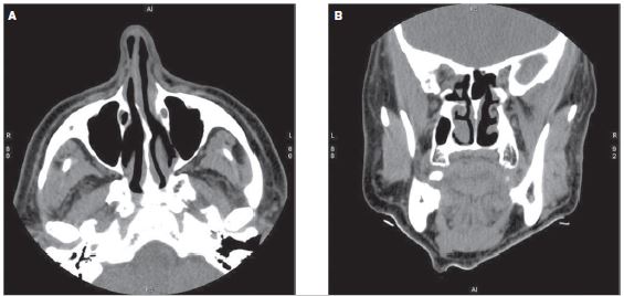 26+ Coronal Plane Mri Photos