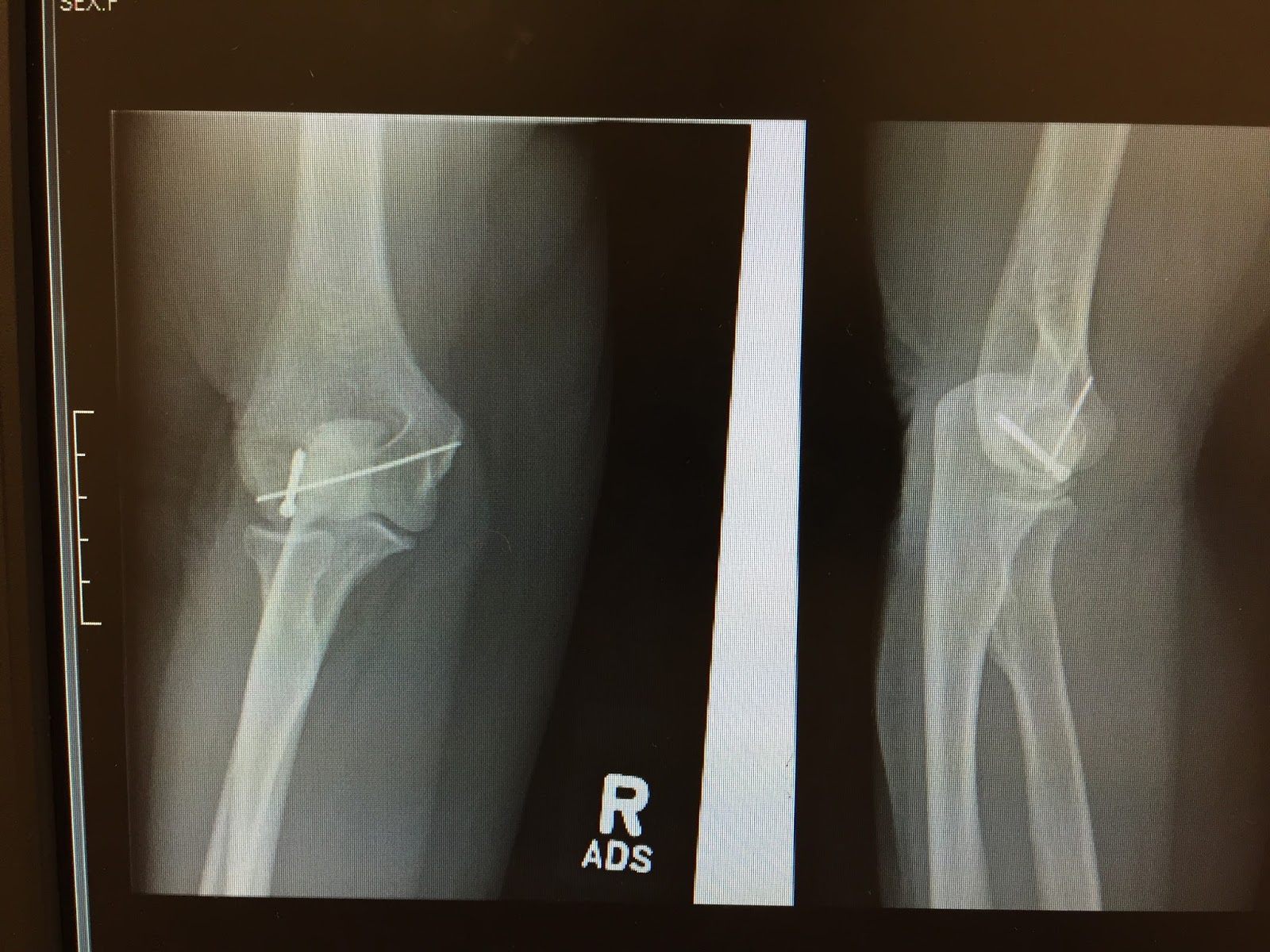shoulder-and-elbow-surgery-shear-fractures-of-the-capitellum