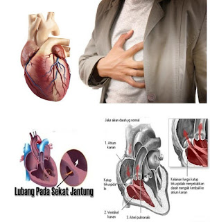 Bila Dibandingkan Dengan Operasi Untuk Mengobati Penyakit Jantung Bocor