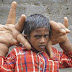Νεαρός στην Ινδία με 12,5 κιλά χέρια [ΕΙΚΟΝΕΣ&ΒΙΝΤΕΟ]