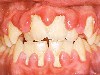 triệu chứng viêm chân răng triệu chứng viêm chân răng