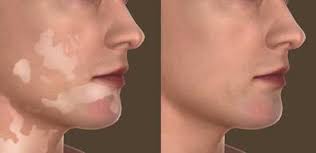 Bạch biến vùng mặt và cách điều trị Chua%2Bbenh%2Bbach%2Bbien