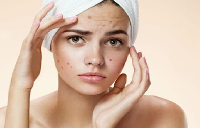 Home Care Treatments for Acne Home Care Treatments for Acne