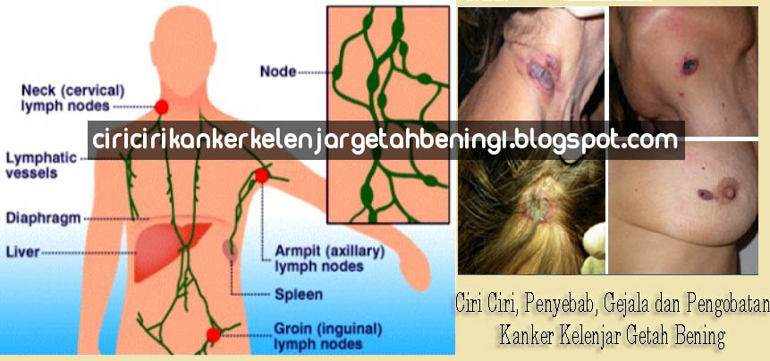 Herpes armpit lymph nodes
