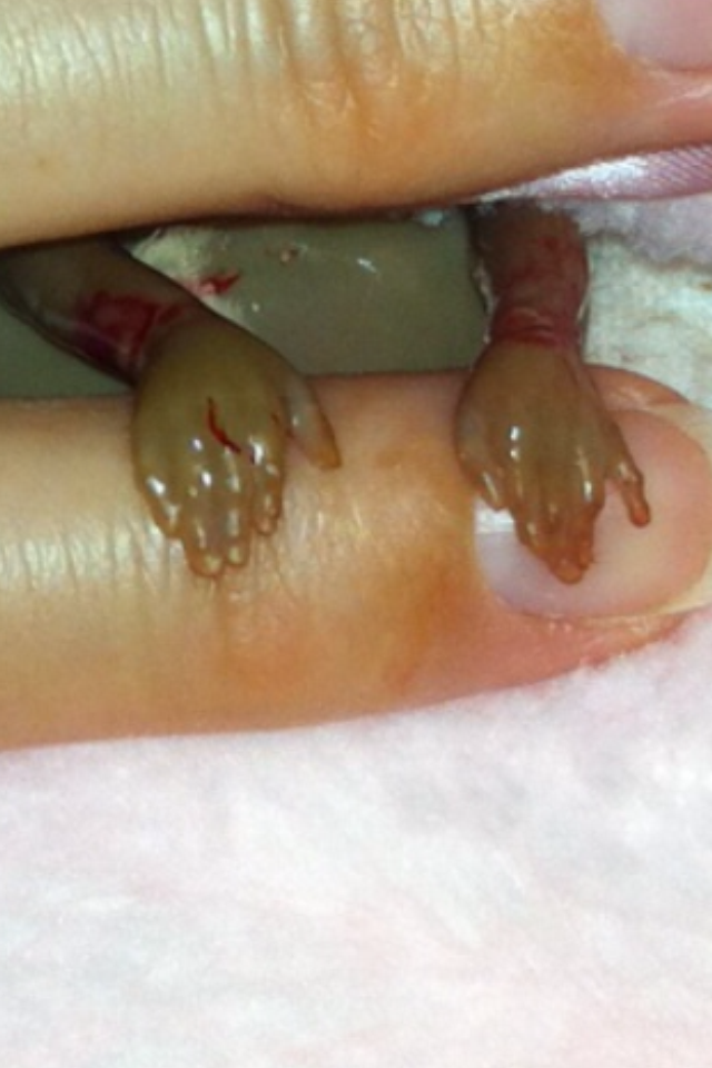 New Abortion 4 Months Apart for Small Space