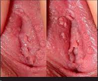 Foto Cara Nyaman Mengatasi Daging Tumbuh Di Bibir Miss V