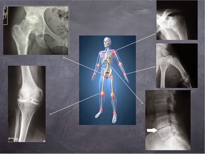 artroza interapofizara durere în mișcare în tratamentul articulației șoldului