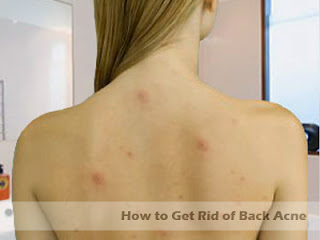  Humans are afflicted with various skin diseases but acne is one of the most common of the How to Get Rid of Back Acne - Proven Back Acne Treatment