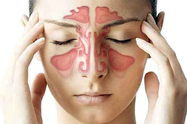 Home Remedies Sinus Headache Home Remedies Sinus Headache