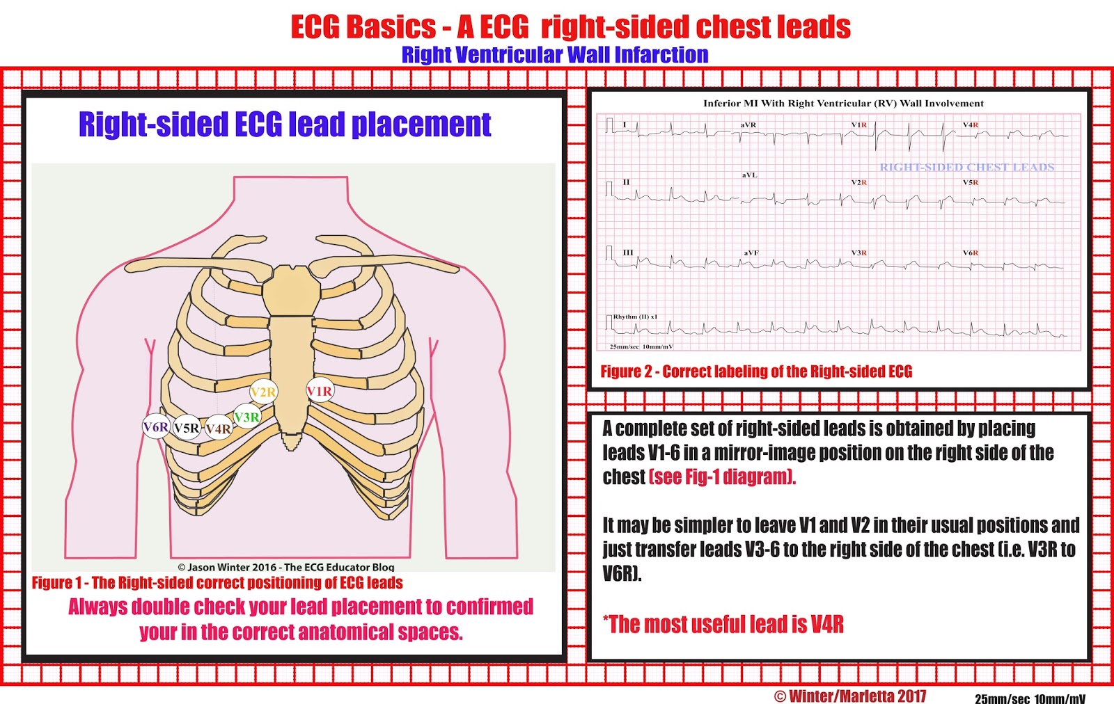 19+ Right Sided Ecg V4R Pictures