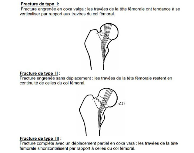 Un médecin du sport vous informe Fractures du col du fémur