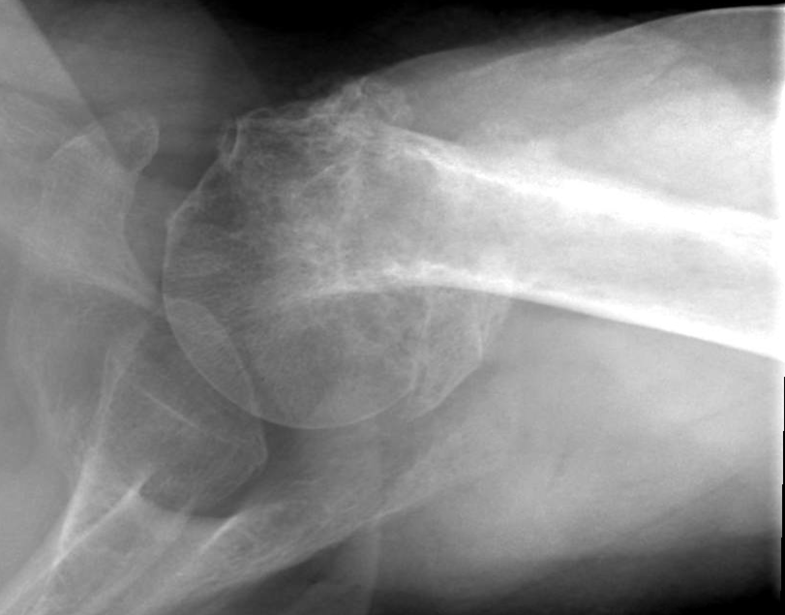 Shoulder and Elbow Surgery Osteoporosis and collapse of the head after