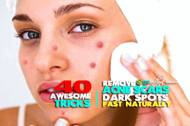 Get How Remedies Acne Rid Scars Home To Fast Of Get How Remedies Acne Rid Scars Home To Fast Of