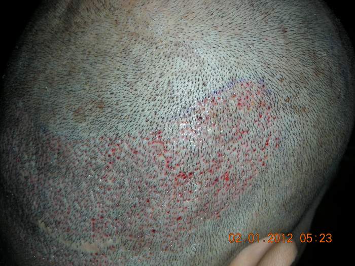 Hair Transplant,Hair Restoration,FUE in Ireland