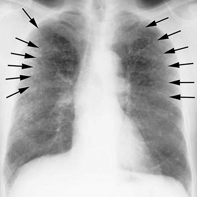 Study Medical Photos Asbestosis And The Pneumoconioses (With X rays