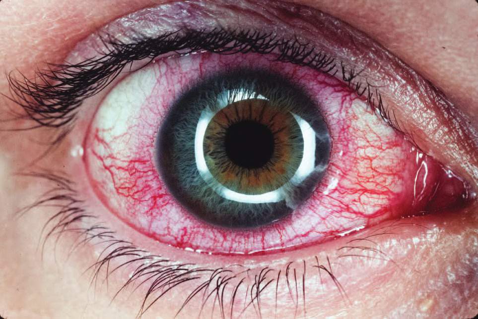 study medical photos anterior uveitis iritis posterior uveitis