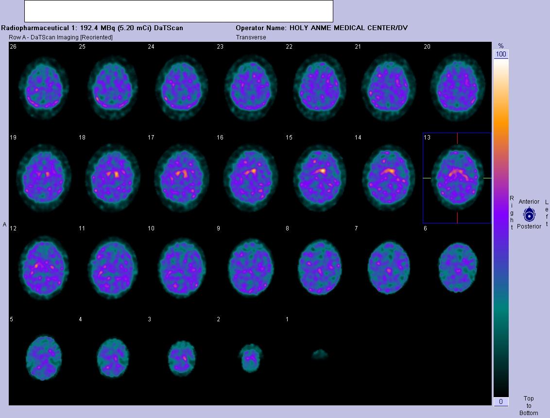 Nuclear Medicine Technology Program DAT SCAN