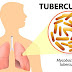 TUBERCULOSIS