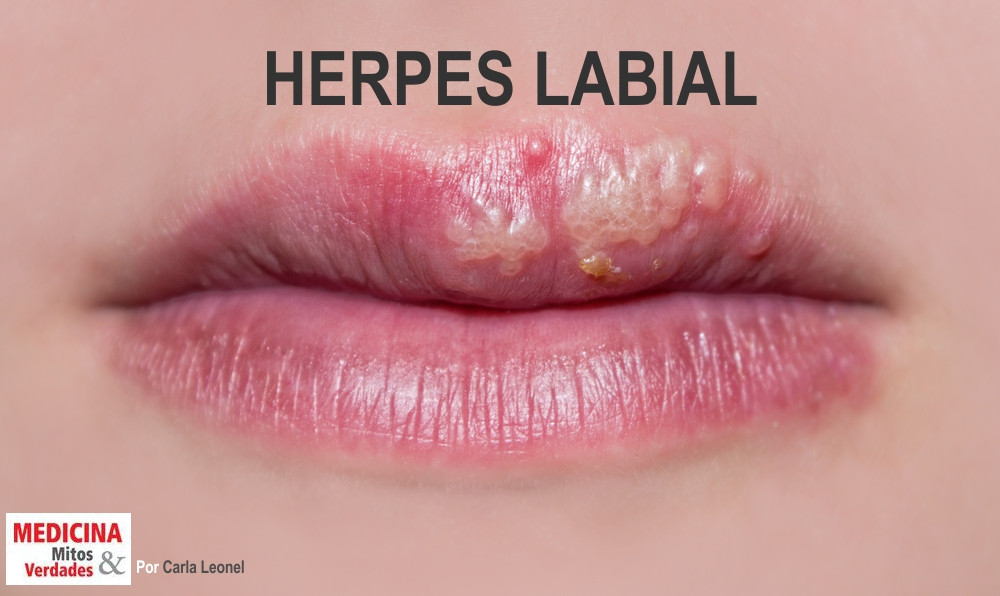 papilloma virus e un herpes